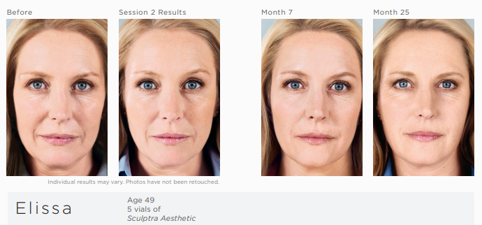 Sculptra® Aesthetic