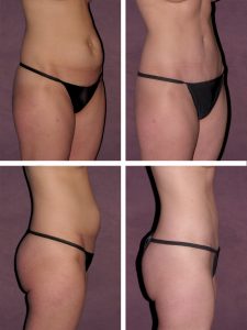 How to Ged Rid of a Stubborn Tummy Pooch