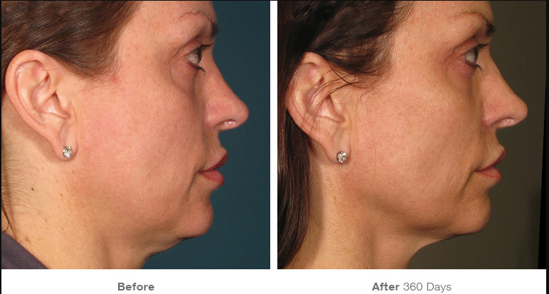 How Long Does Ultherapy® Last?