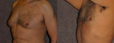 Enlarged Male Breasts Are More Common Than You Realize