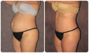 Still Look Pregnant? Diastasis Recti Could Be the Reason