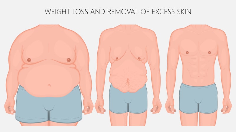 TRUE FORM ABDOMINOPLASTY® and Liposuction: Are They Weight-Loss Procedures?
