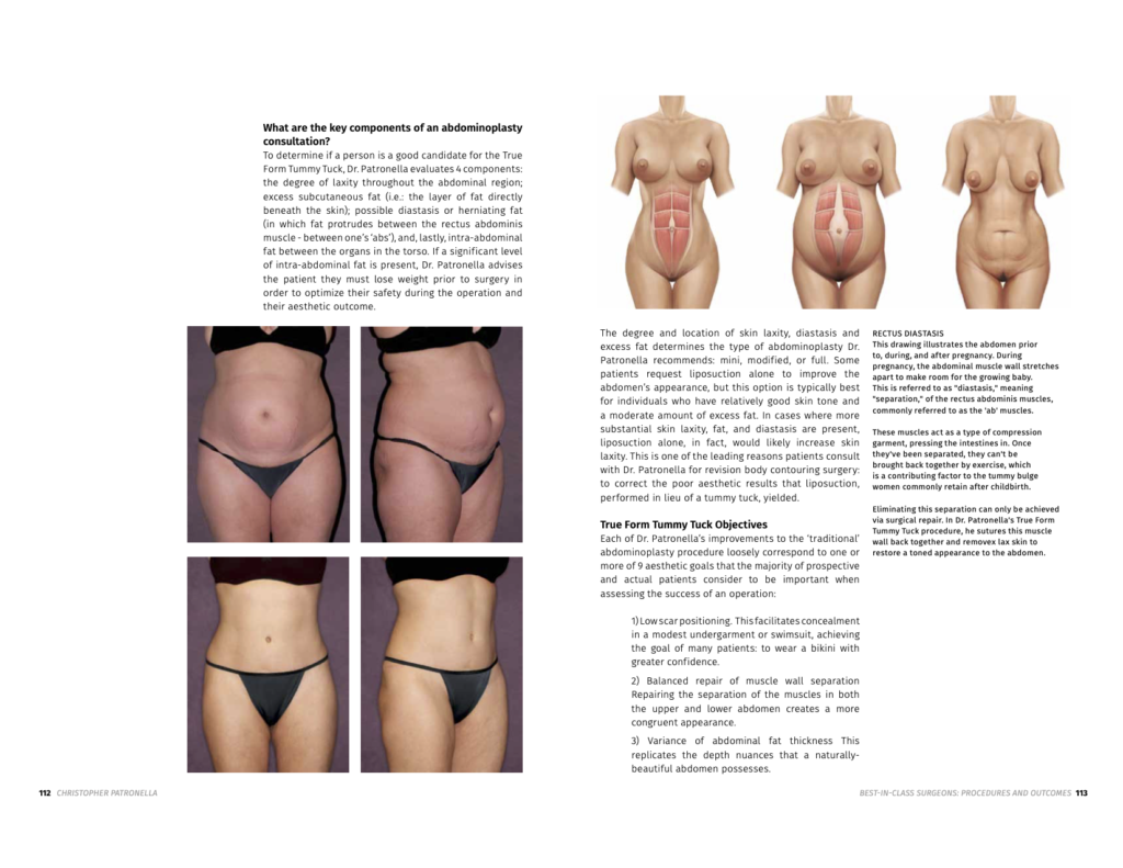 The True Form Tummy Tuck - A New Approach To Abdominoplasty