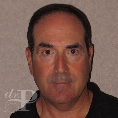 Case--29562 | After Eyelid Surgery (Blepharoplasty) 1