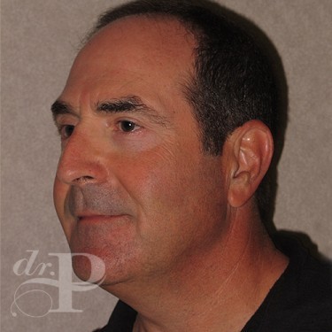 Case--29562 | After Eyelid Surgery (Blepharoplasty) 2