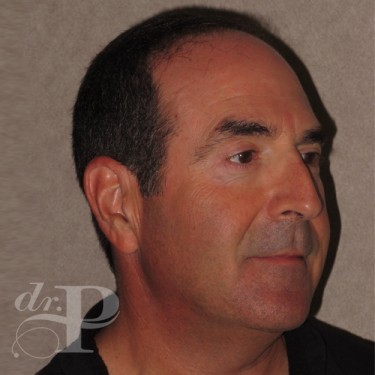 Case--29562 | After Eyelid Surgery (Blepharoplasty) 4