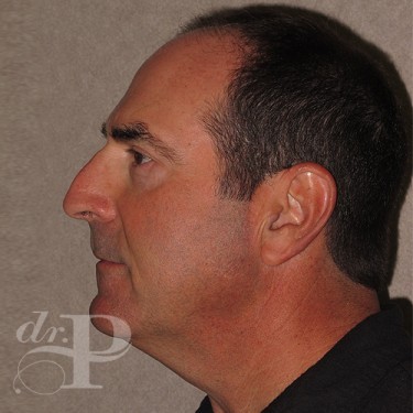 Case--29562 | After Eyelid Surgery (Blepharoplasty) 3