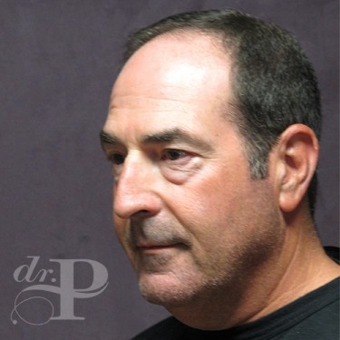 Case--29562 | Before Eyelid Surgery (Blepharoplasty) 2