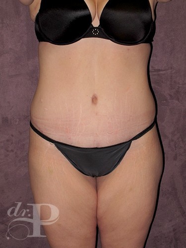 Case--30008 | After True Form Tummy Tuck® with Lower Body Lift (Buttock Lift) 1