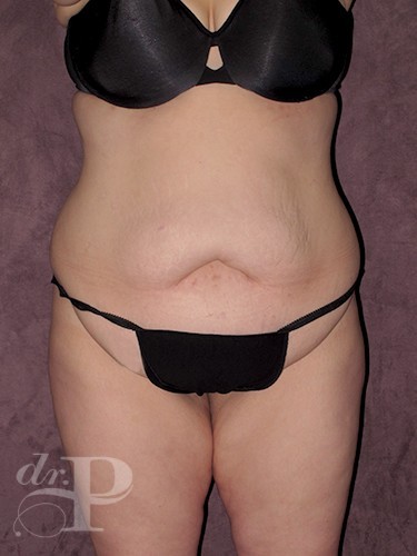Case--29998 | Before Lower Body Lift (Buttock Lift) 1