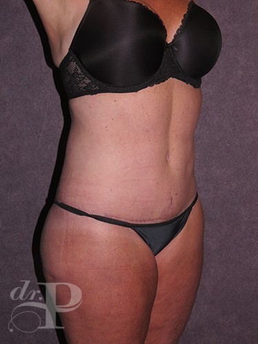 Case--30480 | After Lower Body Lift (Buttock Lift) 2