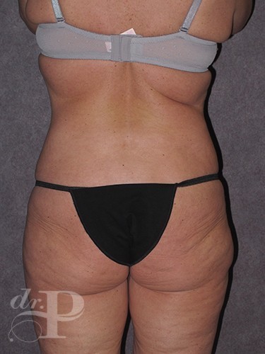 Case--30480 | Before Lower Body Lift (Buttock Lift) 4