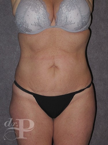 Case--30480 | Before Lower Body Lift (Buttock Lift) 1