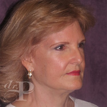 Case--30025 | After Eyelid Surgery (Blepharoplasty) 4