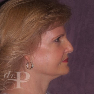 Case--30025 | After Eyelid Surgery (Blepharoplasty) 5