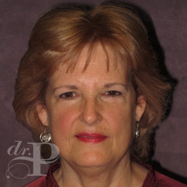 Case--30025 | Before Eyelid Surgery (Blepharoplasty) 1