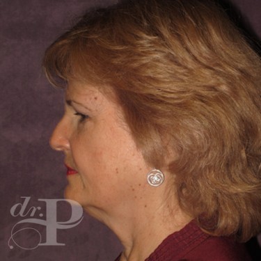 Case--30025 | Before Eyelid Surgery (Blepharoplasty) 3