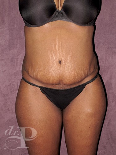 Case--713 | Before Tummy Tuck - Corrective/Revision 1