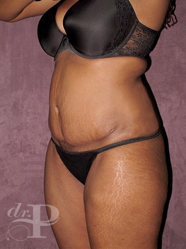 Case--713 | Before Tummy Tuck - Corrective/Revision 2