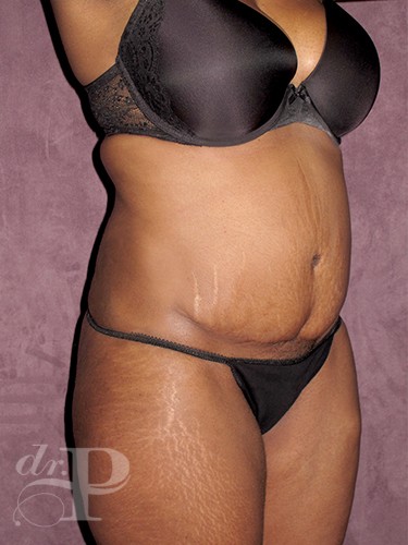 Case--713 | Before Tummy Tuck - Corrective/Revision 4
