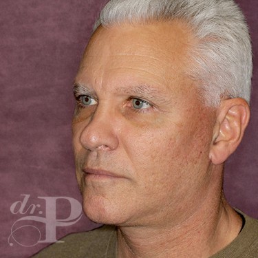 Case--28602 | After Eyelid Lift for Men 2