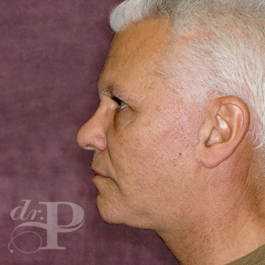 Case--28602 | After Eyelid Lift for Men 3