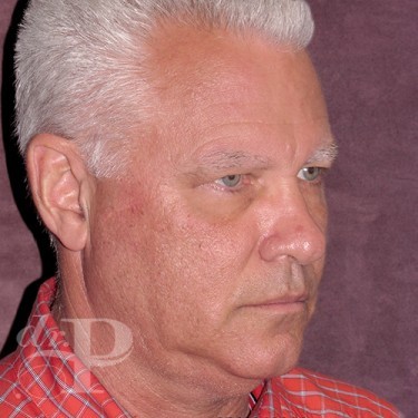 Case--28602 | Before Eyelid Lift for Men 4