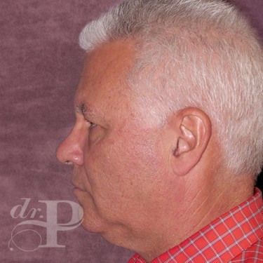 Case--28602 | Before Eyelid Lift for Men 3