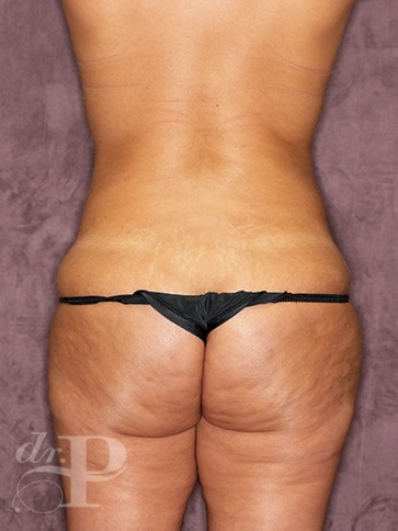 Case--30251 | Before True Form Tummy Tuck® with Lower Body Lift (Buttock Lift) 4