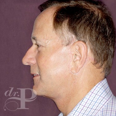 Case--28856 | After Eyelid Lift for Men 3