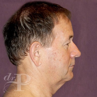 Case--28856 | Before Eyelid Lift for Men 5