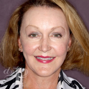Case--28654 | After Eyelid Surgery (Blepharoplasty) 1