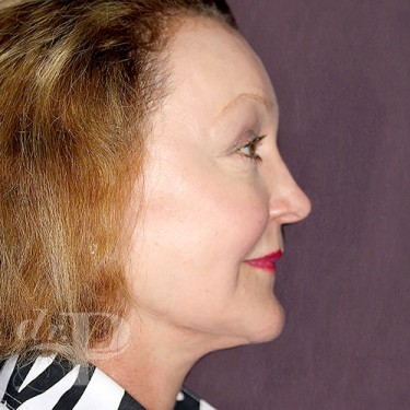Case--28654 | After Eyelid Surgery (Blepharoplasty) 5