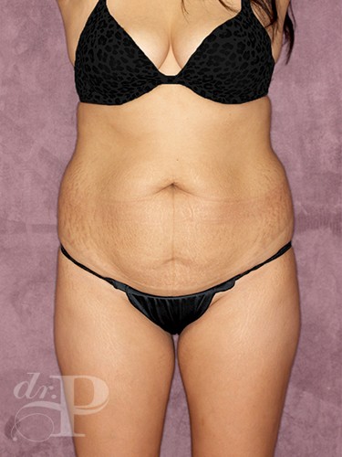 Case--374 | Before True Form Tummy Tuck® 1
