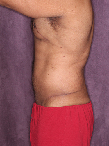 Case--33073 | After True Form Tummy Tuck® for Men 5