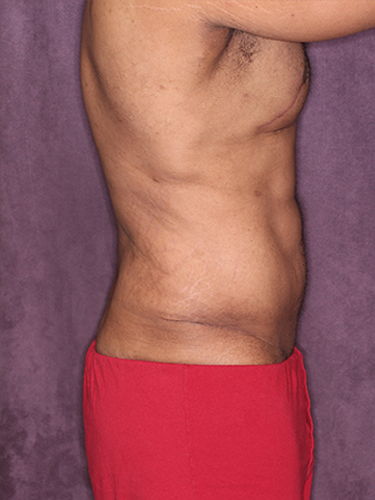 Case--33073 | After True Form Tummy Tuck® for Men 4