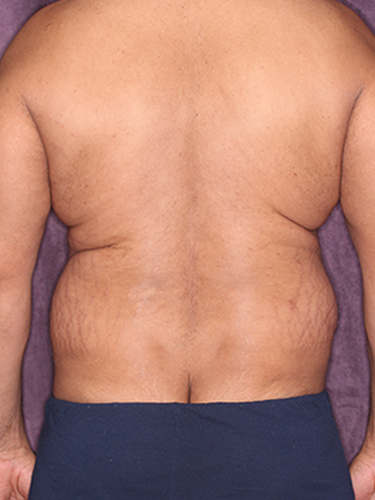 Case--33073 | Before True Form Tummy Tuck® for Men 6