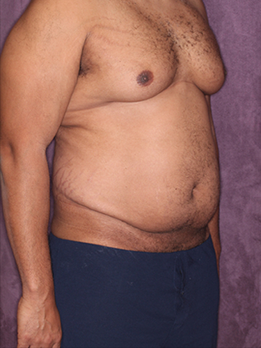 Case--33073 | Before True Form Tummy Tuck® for Men 2