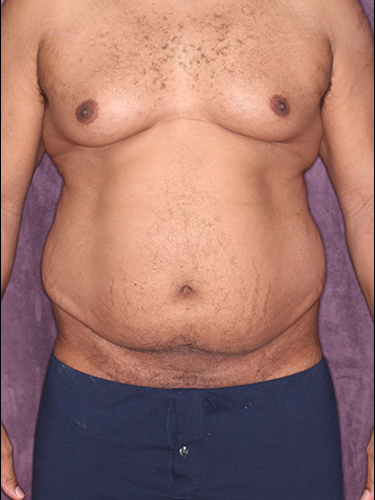 Case--33073 | Before True Form Tummy Tuck® for Men 1