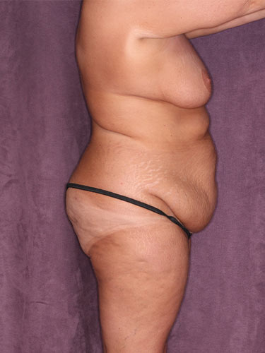 Case--34038 | Before True Form Tummy Tuck® in Overweight & Weight Loss Patients 4