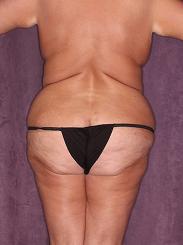 Case--34038 | Before True Form Tummy Tuck® in Overweight & Weight Loss Patients 6