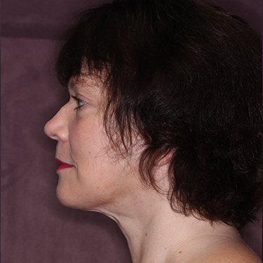 Case--35120 | After Fat Grafting 5