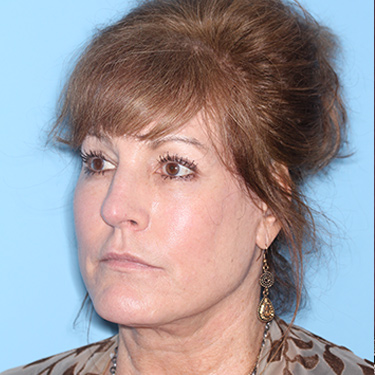 Case--36762 | After Eyelid Surgery (Blepharoplasty) 3