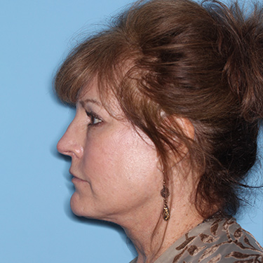 Case--36762 | After Eyelid Surgery (Blepharoplasty) 5