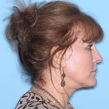 Case--36762 | After Eyelid Surgery (Blepharoplasty) 4