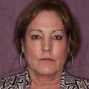 Case--36762 | Before Eyelid Surgery (Blepharoplasty) 1