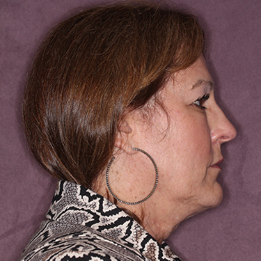 Case--36762 | Before Eyelid Surgery (Blepharoplasty) 4