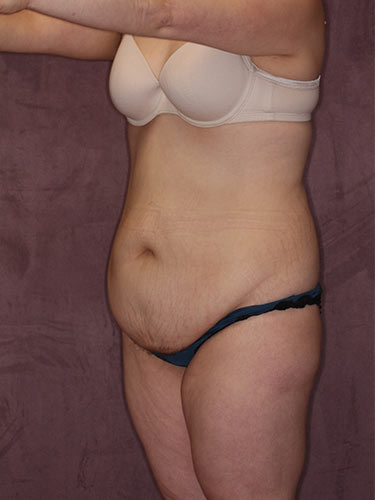 Case--34146 | Before Fat Transfer to Buttocks 3