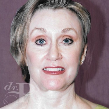 Case--30077 | After Skin Rejuvenation 1