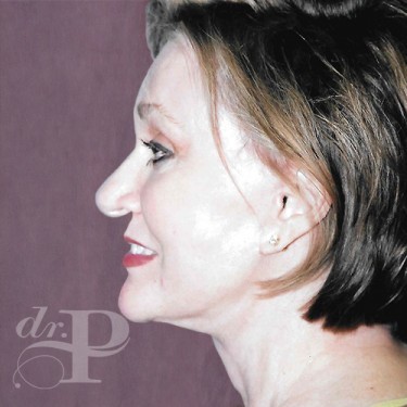 Case--30077 | After Skin Rejuvenation 2